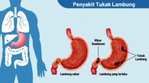 Tukak Lambung vs Maag Apa Bedanya dan Cara Mengobatinya